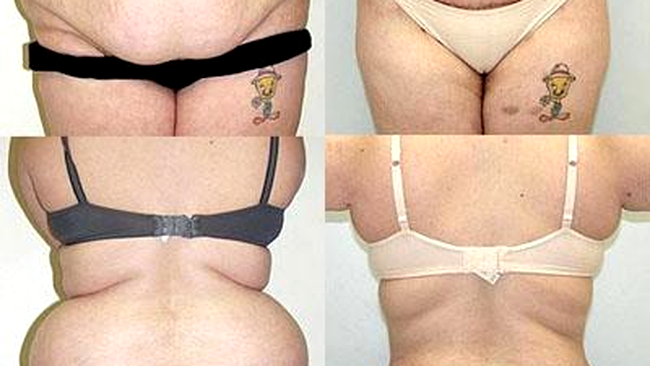 Abdominoplastie